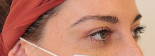 Blepharoplasty Before & After Gallery - Patient 200908 - Image 4
