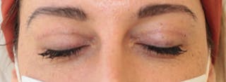 Blepharoplasty Before & After Gallery - Patient 200908 - Image 6