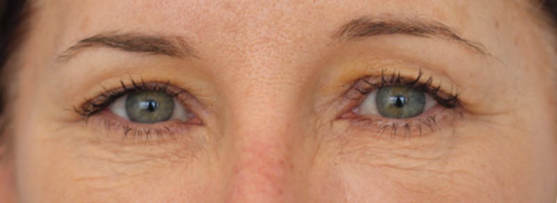 Blepharoplasty Before & After Gallery - Patient 397643 - Image 1