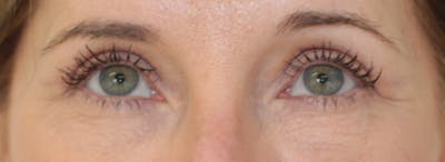 Blepharoplasty Before & After Gallery - Patient 397643 - Image 2