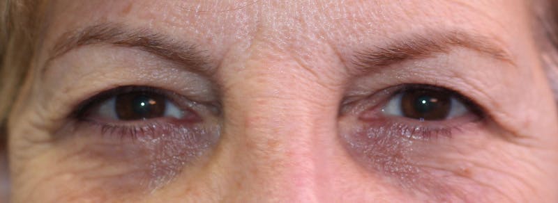 Blepharoplasty Before & After Gallery - Patient 173353 - Image 1