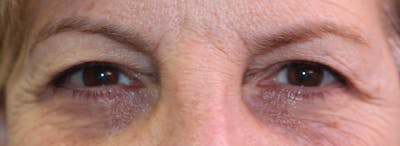 Blepharoplasty Before & After Gallery - Patient 173353 - Image 1