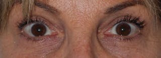 Blepharoplasty Before & After Gallery - Patient 173353 - Image 2