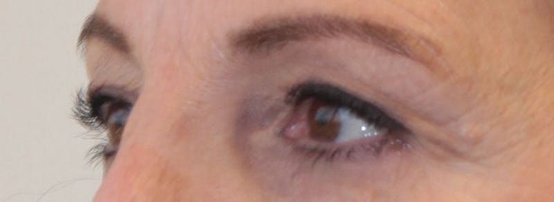 Blepharoplasty Before & After Gallery - Patient 173353 - Image 3