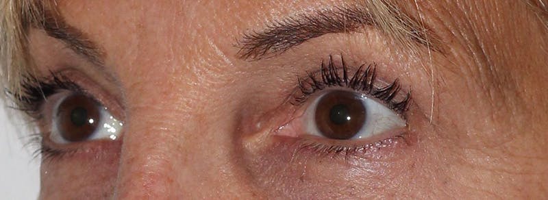 Blepharoplasty Before & After Gallery - Patient 173353 - Image 4