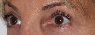 Blepharoplasty Before & After Gallery - Patient 173353 - Image 4