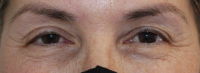 Blepharoplasty Before & After Gallery - Patient 341208 - Image 1