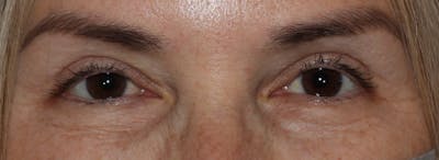 Blepharoplasty Before & After Gallery - Patient 341208 - Image 2