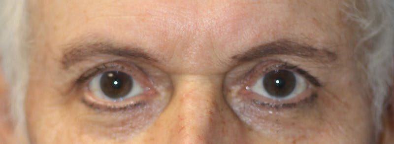 Brow Lift Before & After Gallery - Patient 192465 - Image 1