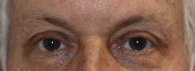 Brow Lift Before & After Gallery - Patient 192465 - Image 2