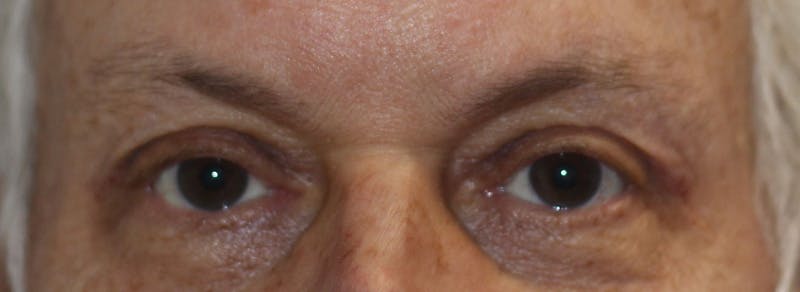 Brow Lift Before & After Gallery - Patient 192465 - Image 2