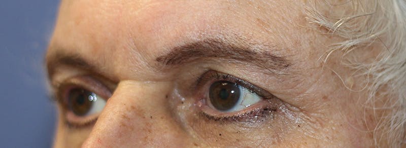 Brow Lift Before & After Gallery - Patient 192465 - Image 3
