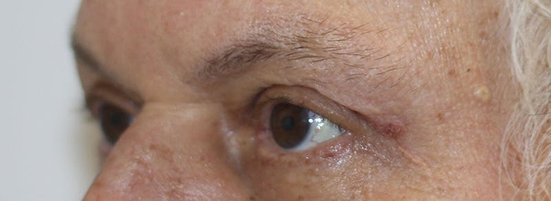 Brow Lift Before & After Gallery - Patient 192465 - Image 4