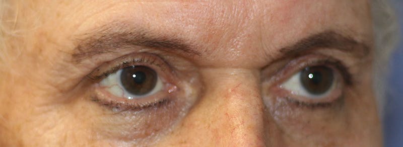 Brow Lift Before & After Gallery - Patient 192465 - Image 5