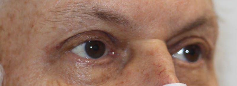 Brow Lift Before & After Gallery - Patient 192465 - Image 6