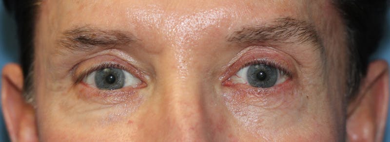 Blepharoplasty Before & After Gallery - Patient 225409 - Image 1