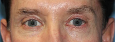 Blepharoplasty Before & After Gallery - Patient 225409 - Image 1