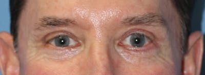 Blepharoplasty Before & After Gallery - Patient 225409 - Image 2