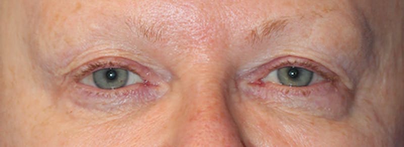 Blepharoplasty Before & After Gallery - Patient 124151 - Image 1