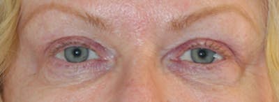Blepharoplasty Before & After Gallery - Patient 124151 - Image 2