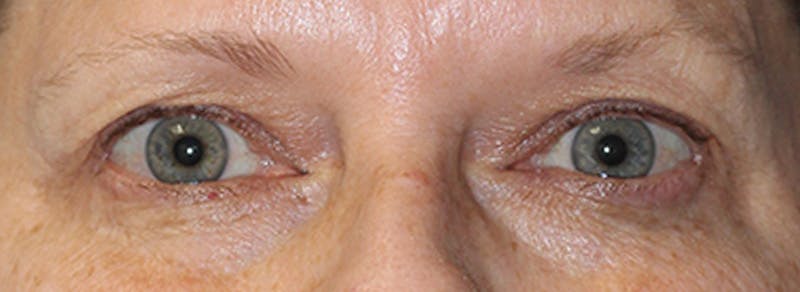 Blepharoplasty Before & After Gallery - Patient 245926 - Image 1