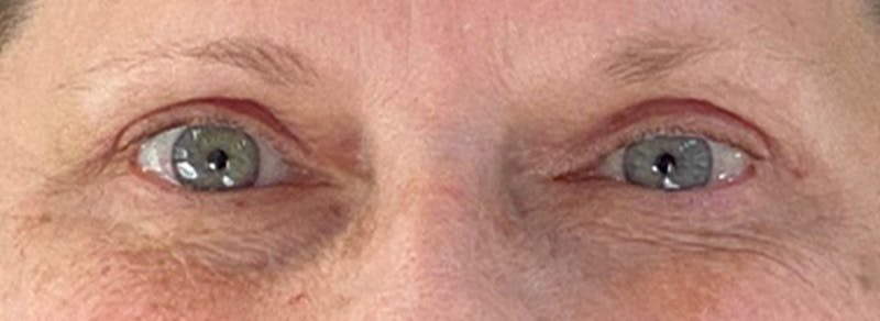 Blepharoplasty Before & After Gallery - Patient 245926 - Image 2