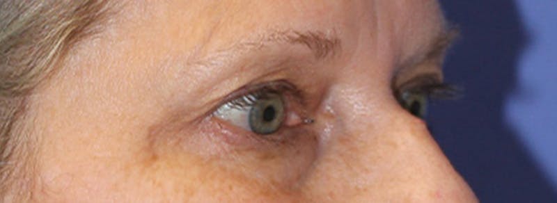 Blepharoplasty Before & After Gallery - Patient 245926 - Image 3