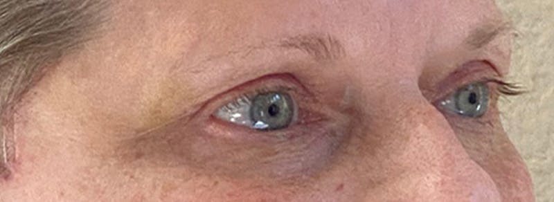 Blepharoplasty Before & After Gallery - Patient 245926 - Image 4