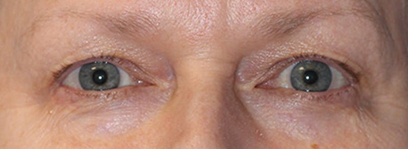 Blepharoplasty Before & After Gallery - Patient 162544 - Image 1
