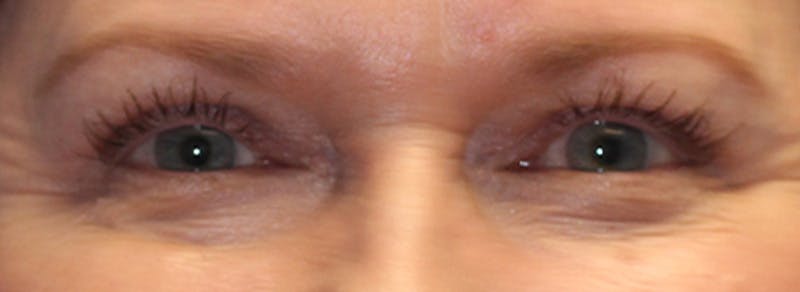 Blepharoplasty Before & After Gallery - Patient 162544 - Image 2
