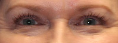 Blepharoplasty Before & After Gallery - Patient 162544 - Image 2