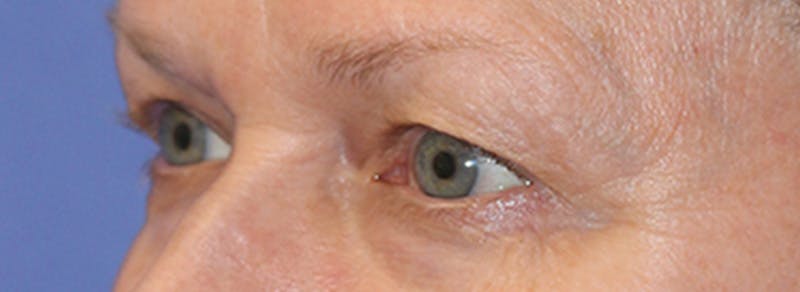Blepharoplasty Before & After Gallery - Patient 162544 - Image 3