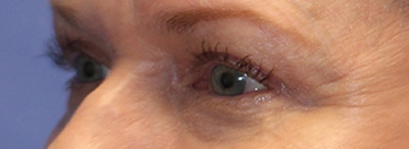 Blepharoplasty Before & After Gallery - Patient 162544 - Image 4
