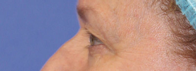 Blepharoplasty Before & After Gallery - Patient 162544 - Image 5