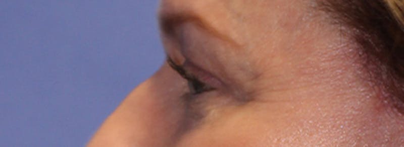 Blepharoplasty Before & After Gallery - Patient 162544 - Image 6