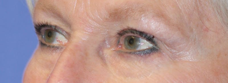 Blepharoplasty Before & After Gallery - Patient 259535 - Image 1