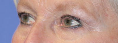 Blepharoplasty Before & After Gallery - Patient 259535 - Image 1