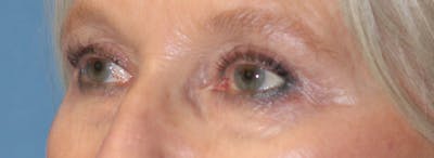 Blepharoplasty Before & After Gallery - Patient 259535 - Image 2