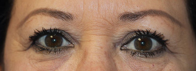 Blepharoplasty Before & After Gallery - Patient 403382 - Image 1