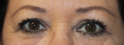 Blepharoplasty Before & After Gallery - Patient 403382 - Image 1