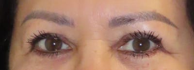 Blepharoplasty Before & After Gallery - Patient 403382 - Image 2