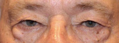 Blepharoplasty Before & After Gallery - Patient 221998 - Image 1