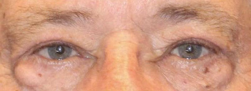 Blepharoplasty Before & After Gallery - Patient 221998 - Image 2