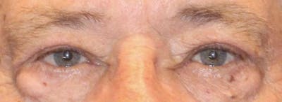 Blepharoplasty Before & After Gallery - Patient 221998 - Image 2