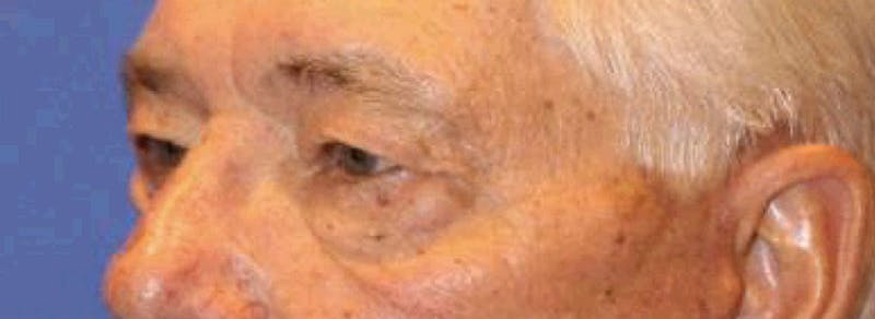 Blepharoplasty Before & After Gallery - Patient 221998 - Image 3
