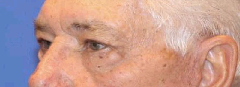 Blepharoplasty Before & After Gallery - Patient 221998 - Image 4
