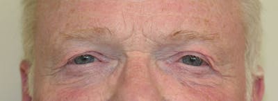 Blepharoplasty Before & After Gallery - Patient 299402 - Image 1