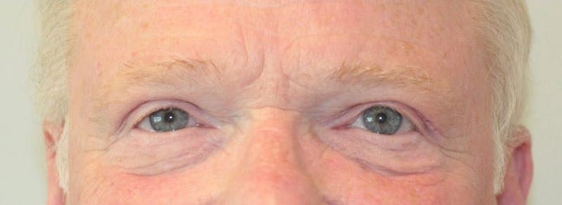 Blepharoplasty Before & After Gallery - Patient 299402 - Image 2