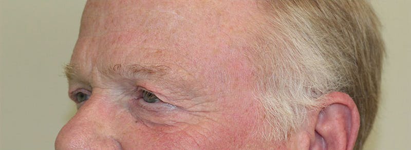 Blepharoplasty Before & After Gallery - Patient 299402 - Image 3