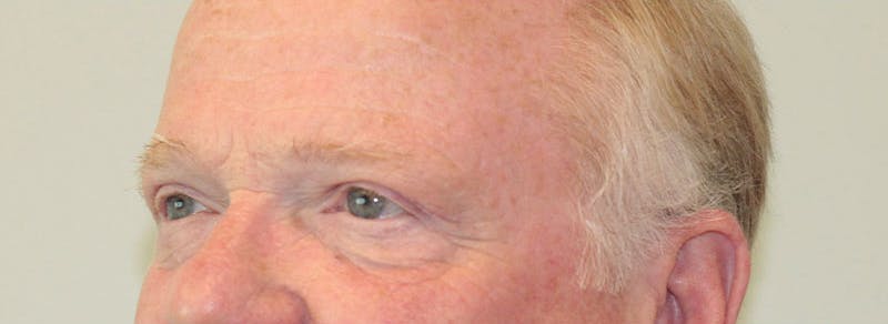 Blepharoplasty Before & After Gallery - Patient 299402 - Image 4